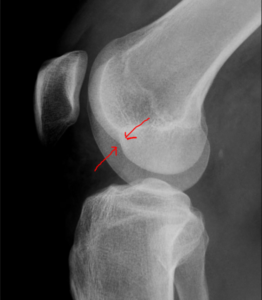 knee xray
