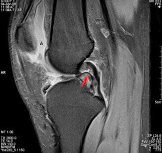 Test Your X Ray Iq Knee Pain Airrosti