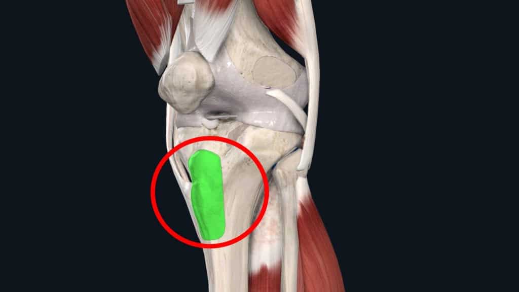 Osgood Schlatter Disease in Adults: Treatment for Knee Pain