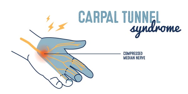 Carpal Tunnel Syndrome Illustration