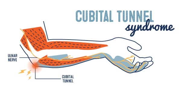 Cubital Tunnel Syndrome Illustration