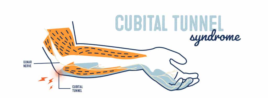 Cubital Tunnel Syndrome